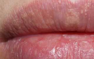 Пигментные пятна на губах — виды и как их лечить