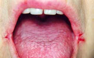 11 причин трещин в уголках рта и их лечение