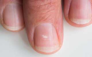 Белые пятна на ногтях рук — почему появляются и как избавится