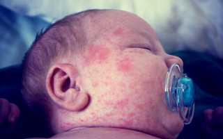 Диатез у ребенка — генетическая предрасположенность к аллергии