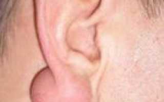 Шарики в мочке уха — стоит ли переживать?