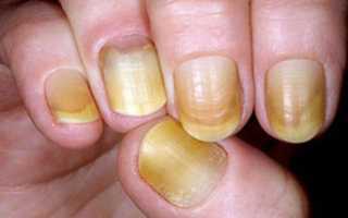 Отходят ногти от кожи на руках — почему и что делать?