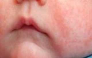Сыпь на лице у новорожденного ребенка до 1 месяца