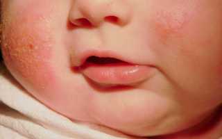 Как проявляется аллергический дерматит у детей