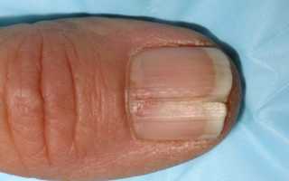 Почему появляются трещины на ногтях рук