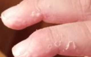 Почему шелушится кожа на ладонях и пальцах рук?